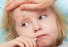 Прививка против кори детям: сроки и правила вакцинации